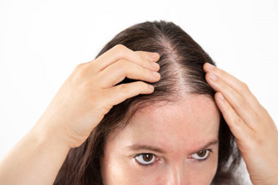 3 Causes of Female Menopausal Hair Loss